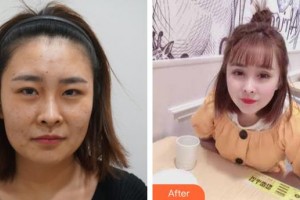 襄陽韓美醫(yī)療美容醫(yī)院李江整形價(jià)格表附膨體隆鼻案例展示