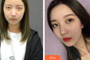 襄陽(yáng)漢辰醫(yī)療美容門診部劉俊慧整形價(jià)格表附自體脂肪全臉填充案例展示