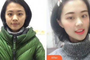 襄陽(yáng)伊爾美整形美容醫(yī)院張?jiān)抡蝺r(jià)格表附眼部綜合案例展示