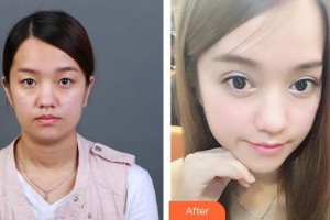 襄陽(yáng)愛(ài)爾眼科醫(yī)院龔麟整形價(jià)格表附切開雙眼皮案例展示
