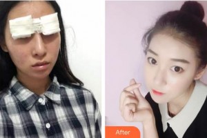 襄陽(yáng)愛(ài)爾眼科醫(yī)院趙建敏整形價(jià)格表附切開雙眼皮案例展示