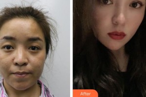 襄陽(yáng)愛(ài)爾眼科醫(yī)院胡琴整形價(jià)格表附切開雙眼皮案例展示