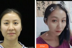 襄陽(yáng)愛(ài)爾眼科醫(yī)院朱琴整形價(jià)格表附眼部修復(fù)案例展示