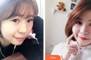 襄陽(yáng)愛(ài)爾眼科醫(yī)院楊賀斌整形價(jià)格表附切開雙眼皮案例展示