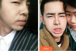 襄陽奧益齒口腔診所沈俊波整形價格表附金屬托槽矯正案例展示