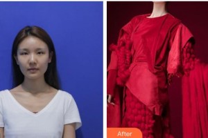 恩施慧益眼科醫(yī)院蘆曉磊整形價格表附上眼瞼去脂案例展示
