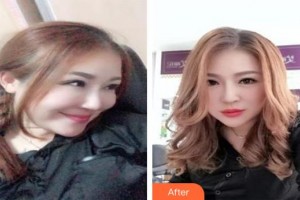 仙桃友好醫(yī)學(xué)美容醫(yī)院張志翔整形價格表附嗨體去頸紋案例展示