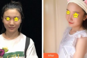 仙桃憶美醫(yī)療美容門診部解永學(xué)整形價格表附埋線提升案例展示