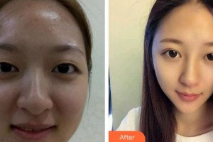 潛江亞美醫(yī)療美容診所雷云菲整形價格表附眼部修復(fù)案例展示