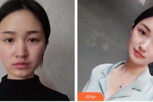 天門江岳醫(yī)療美容診所李龍整形價格表附眼部綜合案例展示