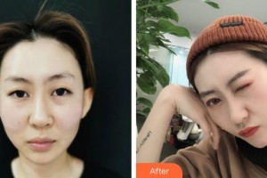 萍鄉(xiāng)星悅醫(yī)療美容診所嚴友才整形價格表附埋線提升案例展示
