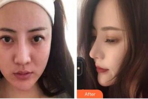 九江圣嘉麗醫(yī)療美容門診部胡南整形價格表附鼻修復案例展示