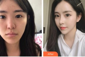 九江學院附屬醫(yī)院整形美容科詹太國整形價格表附鼻部綜合案例展示