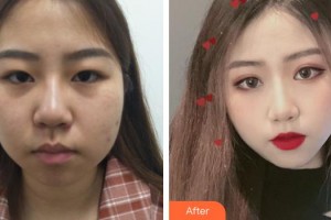 九江風華醫(yī)療美容門診部黃健生整形價格表附假體隆鼻案例展示