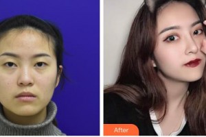 九江風華醫(yī)療美容門診部宋志剛整形價格表附鼻部綜合案例展示