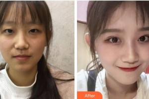 九江愛爾中山眼科醫(yī)院李紅鳴整形價格表附切開雙眼皮案例展示