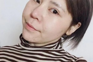 贛州明珠麗格醫(yī)療美容醫(yī)院劉巍整形價格表附眼部綜合案例展示