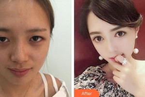 宜春學(xué)院整形美容醫(yī)院易院玲整形價(jià)格表附切開雙眼皮案例展示