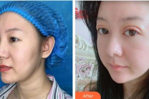 宜春美萊醫(yī)療美容門診部黃治林整形價(jià)格表附眼部綜合案例展示