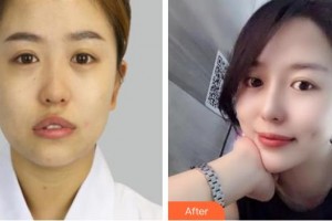 撫州江醫(yī)生醫(yī)療美容門診部江娟萍整形價格表附眼部修復(fù)案例展示
