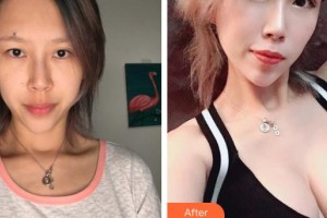 上饒尚美醫(yī)療美容門診部劉芳艷整形價格表附埋線提升案例展示