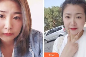上饒協(xié)和醫(yī)院整形美容科王雙余整形價(jià)格表附熱拉提案例展示