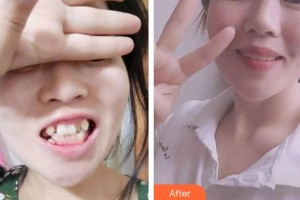 上饒維樂陽光口腔門診部徐奐整形價(jià)格表附金屬托槽矯正案例展示