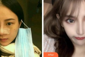 平頂山星美醫(yī)療美容門診部崔啟榮整形價(jià)格表附鼻部綜合案例展示