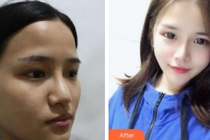 平頂山藝美醫(yī)療美容醫(yī)院任擁軍整形價(jià)格表附鼻部綜合案例展示