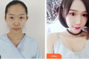 烏魯木齊普瑞眼科醫(yī)院郭云林整形價(jià)格表附切開(kāi)雙眼皮案例展示