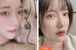 昆山第一人民醫(yī)院燒傷整形科于冶整形價(jià)格表附眼部綜合案例展示