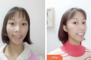 昆山愛(ài)爾眼科醫(yī)院周世芳整形價(jià)格表附口腔美白牙齒案例展示