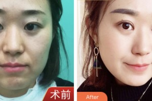 昆山愛(ài)爾眼科醫(yī)院肖耀廷整形價(jià)格表附眼部綜合案例展示