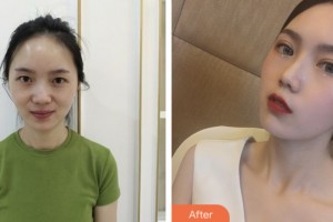 昆山愛(ài)爾眼科醫(yī)院孟亞麗整形價(jià)格表附切開(kāi)雙眼皮案例展示