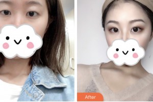 淮安第二人民醫(yī)院整形美容外科陳伏庭整形價(jià)格表附切開(kāi)雙眼皮案例展示