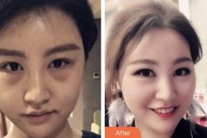 淮安第二人民醫(yī)院整形美容外科陳文斌整形價(jià)格表附內(nèi)切祛眼袋案例展示