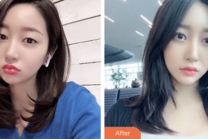 淮安第一人民醫(yī)院整形美容外科封必釗整形價(jià)格表附切開(kāi)雙眼皮案例展示