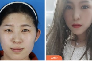 淮安仁愛醫(yī)院醫(yī)療美容科商林生整形價格表附眼部綜合案例展示