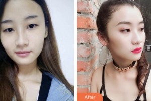 淮安仁愛醫(yī)院醫(yī)療美容科高惠圓整形價格表附切開雙眼皮案例展示