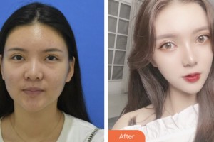 淮安市婦幼保健院醫(yī)療美容科王川穎整形價(jià)格表附激光去眼袋案例展示