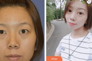 淮安市婦幼保健院醫(yī)療美容科李青國(guó)整形價(jià)格表附切開(kāi)雙眼皮案例展示