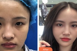 淮安漣水縣人民醫(yī)院燒傷整形科王永超整形價(jià)格表附雙眼皮案例展示