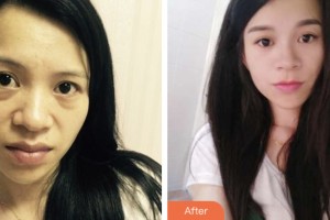 淮安市婦幼保健院醫(yī)療美容科許敏整形價(jià)格表附激光去眼袋案例展示