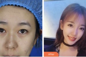 淮安市婦幼保健院醫(yī)療美容科余志芬整形價(jià)格表附切開(kāi)雙眼皮案例展示