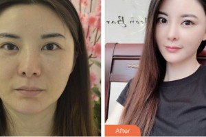 淮安俏美整形美容醫(yī)院李春江整形價(jià)格表附埋線提升案例展示