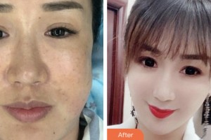 淮安華美整形外科醫(yī)院耿麗紅整形價(jià)格表附埋線提升案例展示