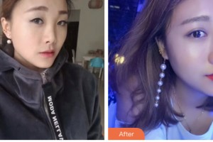 淮安俏美整形美容醫(yī)院朱逸整形價(jià)格表附熱瑪吉案例展示