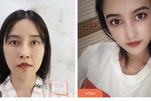 婁底市第一人民醫(yī)院燒傷整形外科周勇整形價格表附鼻修復案例展示