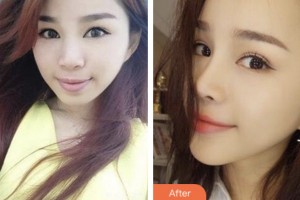 湘潭雅美醫(yī)療美容醫(yī)院田芳斌整形價格表附硅膠隆鼻案例展示