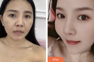 拉薩維多利亞整形美容醫(yī)院范晨光整形價(jià)格表附牙齒陶瓷矯正案例展示